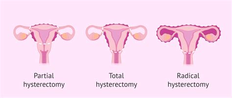 hysterectomy in normanton|Hysterectomy: Why It's Performed, What To Expect After Surgery.